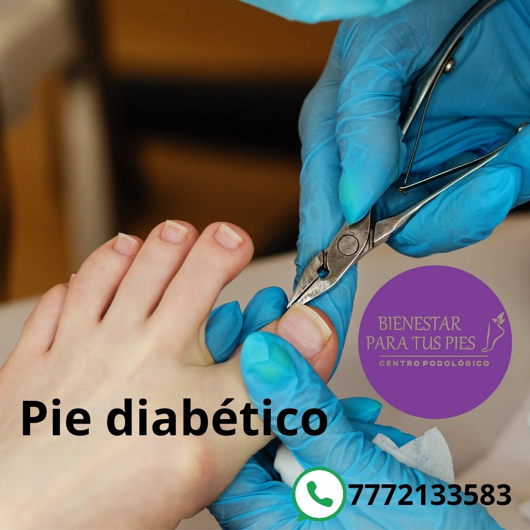Atención a pie diabético
